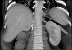 Liver Metastases From Renal Cancer - CTisus CT Scan