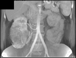 Renal Cell Carcinoma - CTisus CT Scan