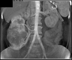 Vascular Renal Cell Carcinoma With 2 Renal Arteries - CTisus CT Scan