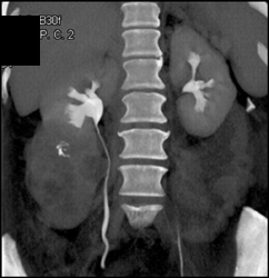 Ct Urogram- Renal Cell Carcinoma - CTisus CT Scan