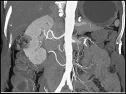 Angiomyolipoma (AML) in 3D - CTisus CT Scan