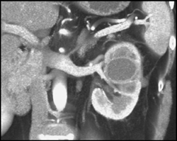 Renal Abscess in Left Kidney - CTisus CT Scan