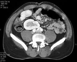 Pelvic Kidney - CTisus CT Scan