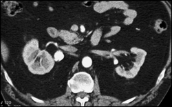 Renal Artery Aneurysm - CTisus CT Scan