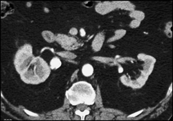 Renal Artery Aneurysm - CTisus CT Scan