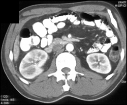 Acute Pyelonephritis (right Kidney) - CTisus CT Scan