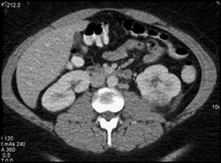 Focal Left Pyelonephritis - CTisus CT Scan