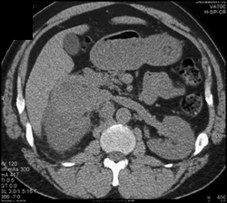 Renal Abscess - CTisus CT Scan