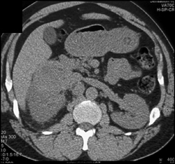 Renal Abscess - CTisus CT Scan