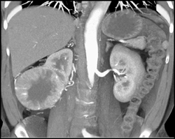 Renal Cell Carcinoma and Hepatic Hemangioma - CTisus CT Scan