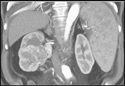 Renal Cell Carcinoma - CTisus CT Scan