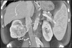 Renal Cell Carcinoma - CTisus CT Scan