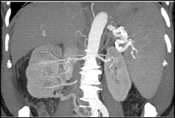 Renal Cell Carcinoma - CTisus CT Scan