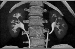 Papillary Necrosis of the Left Kidney - CTisus CT Scan