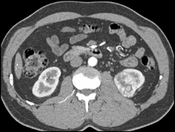 Renal Cell Carcinoma - CTisus CT Scan