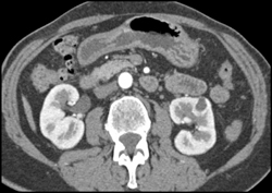 Atypical Cystic Renal Cell Carcinoma - CTisus CT Scan