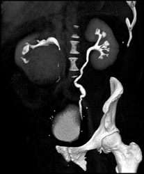 Ct Urogram With Right Renal Cyst - CTisus CT Scan