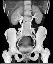 Mild Right Hydronephrosis - CTisus CT Scan