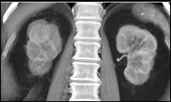 Renal Cell Carcinoma - CTisus CT Scan