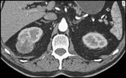 Renal Cell Carcinoma - CTisus CT Scan