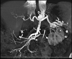 Incidental Right Renal Artery Aneurysm - CTisus CT Scan