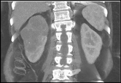 Transitional Cell Carcinoma - CTisus CT Scan