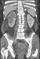 Transitional Cell Carcinoma - CTisus CT Scan