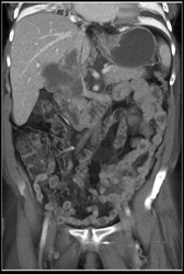 Transitional Cell Cancer (TCC) Invades Renal Vein and IVC - CTisus CT Scan