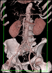 Normal Opaque 3D Rendering - CTisus CT Scan