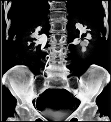 Normal CT Urogram - CTisus CT Scan