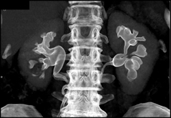 Normal CT Urogram - CTisus CT Scan