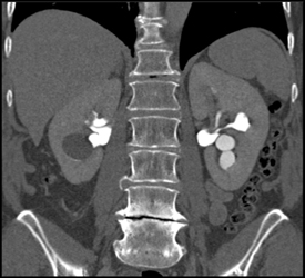 Normal CT Urogram - CTisus CT Scan