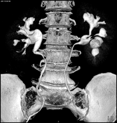 Normal CT Urogram - CTisus CT Scan