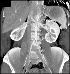 Normal Anatomy - CTisus CT Scan