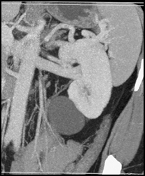 Normal Renal Vein and Renal Cyst - CTisus CT Scan