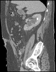 Stone in Distal Ureter to Neobladder - CTisus CT Scan