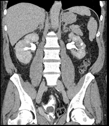 Neobladder With Leak - CTisus CT Scan