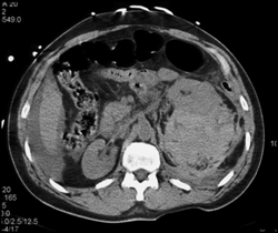 Bleed S/P Renal Bx - CTisus CT Scan