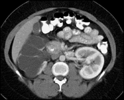 Dysplastic Kidney - CTisus CT Scan