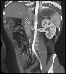 Prehilar Branching to Upper Pole - CTisus CT Scan