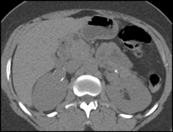 Bilateral Renal Artery Aneurysms - CTisus CT Scan