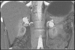 Unsuspected Bilateral Renal Artery Aneurysms - CTisus CT Scan