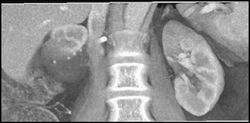 Infarcted Right Kidney (lower Pole) S/P Partial Nephrectomy - CTisus CT Scan