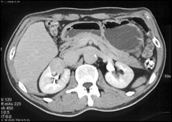 Renal Carcinoma (right Kidney) - CTisus CT Scan