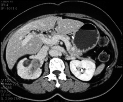 Transitional Cell Carcinoma - CTisus CT Scan