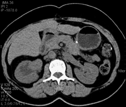 Transitional Cell Carcinoma - CTisus CT Scan