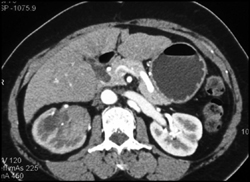 Transitional Cell Carcinoma - CTisus CT Scan