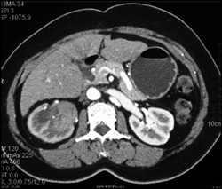 Transitional Cell Carcinoma - CTisus CT Scan