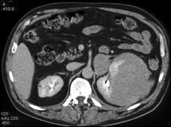 Renal Lymphoma - CTisus CT Scan