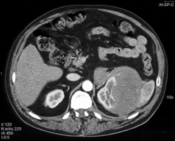 Renal Lymphoma - CTisus CT Scan